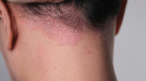 טיפול בסבוריאה עם צמחי מרפא